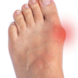 bunion.png