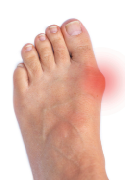bunion.png